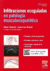 Infiltraciones ecoguiadas en patología musculoesqueletica