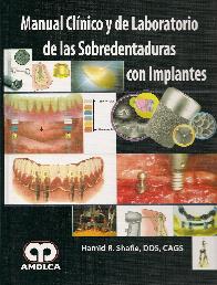Manual Cl�nico y de Laboratorio de las Sobredentaduras con Implantes