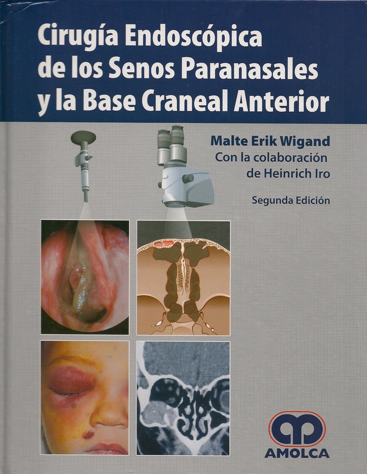 Cirugia Endoscopica de los Senos Paranasales y la Base Craneal Anterior