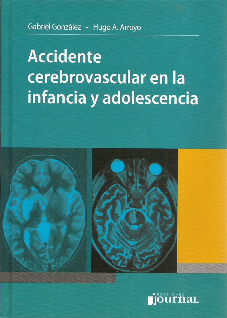 Accidente cerebrovascular en la infancia y adolescencia