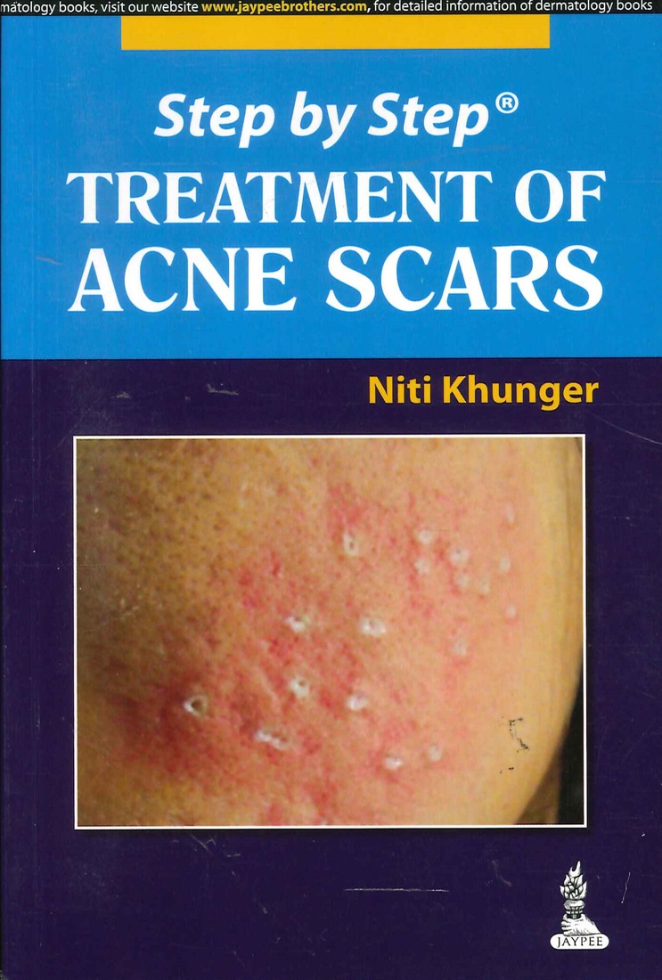 Treatment of Acne Scars