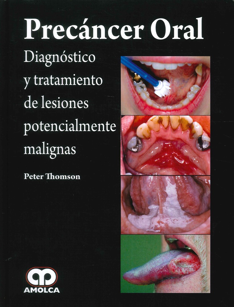 Precncer oral