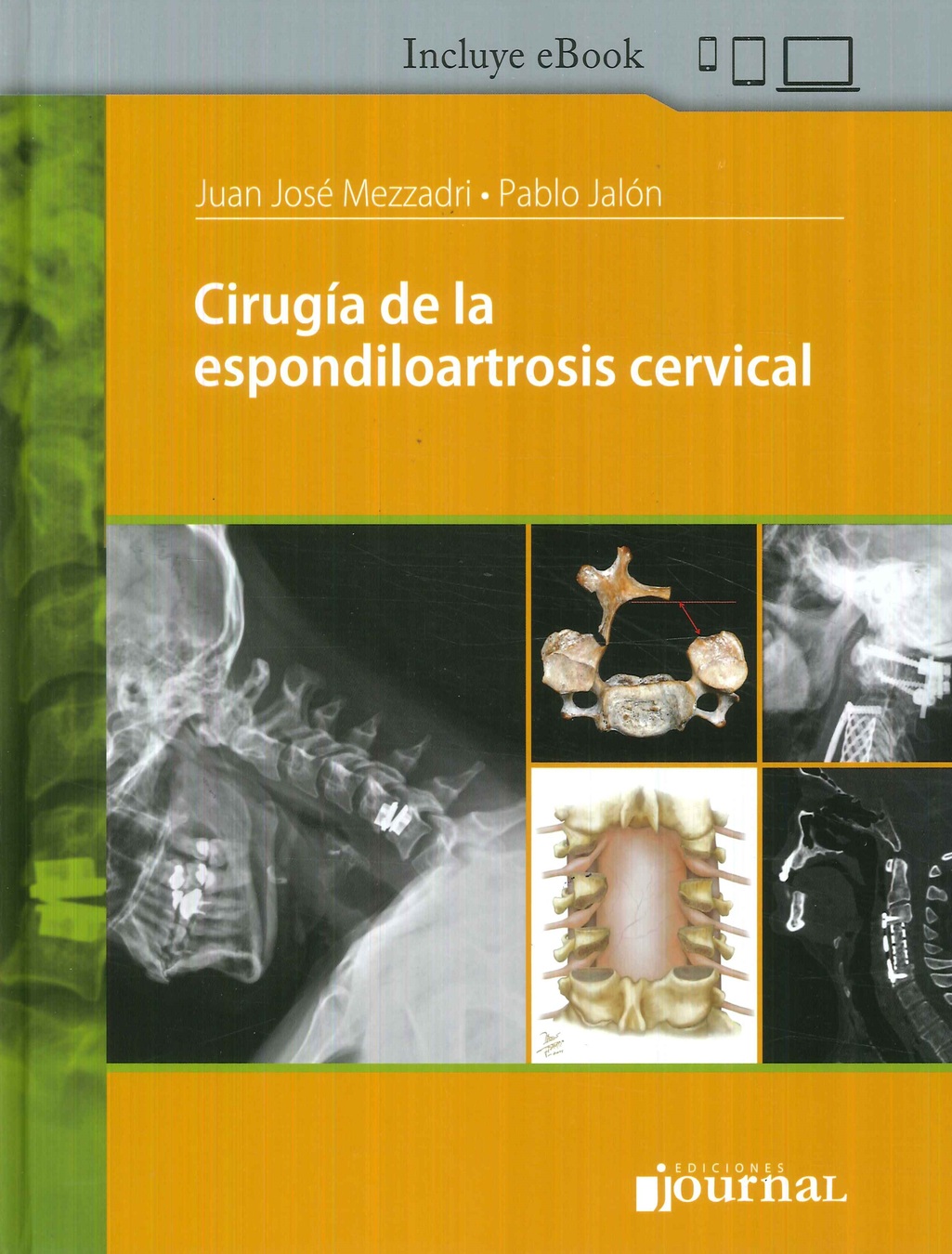 Ciruga de la Espondiloartrosis Cervical