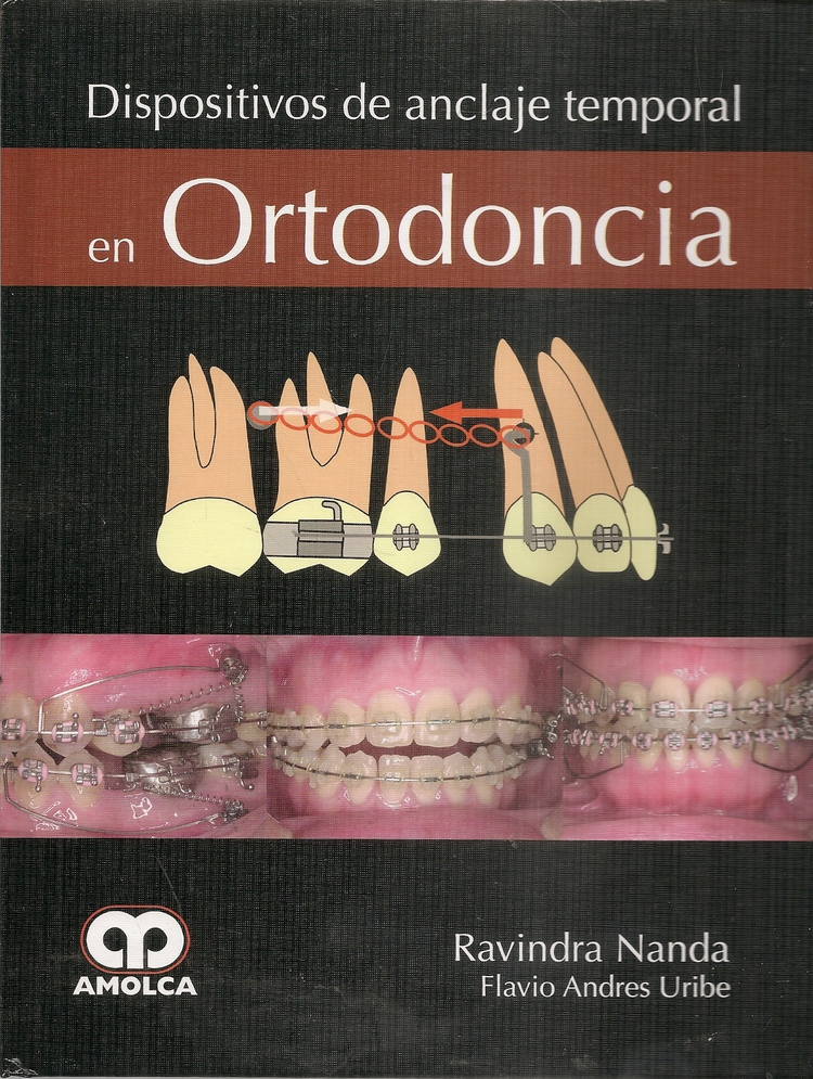 Dispositivos de anclaje temporal en Ortodoncia
