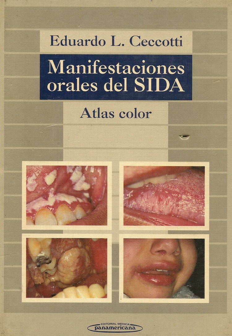 Manifestaciones orales del sida
